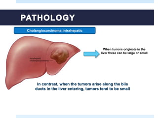 Cholangiocarcinoma intrahepatic
When tumors originate in the
liver these can be large or small
In contrast, when the tumors arise along the bile
ducts in the liver entering, tumors tend to be small
 