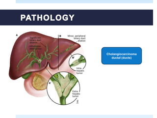 Cholangiocarcinoma
ductal (ducts)
 