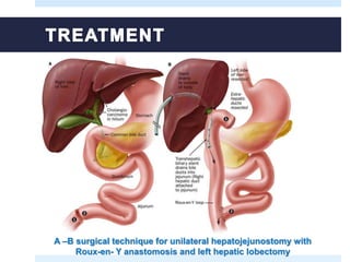 A –B surgical technique for unilateral hepatojejunostomy with
Roux-en- Y anastomosis and left hepatic lobectomy
 