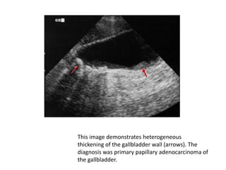 This image demonstrates heterogeneous 
thickening of the gallbladder wall (arrows). The 
diagnosis was primary papillary adenocarcinoma of 
the gallbladder. 
 