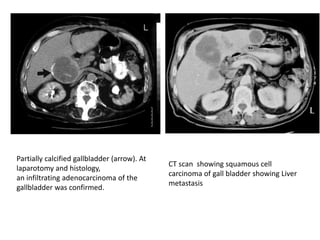 Partially calcified gallbladder (arrow). At 
laparotomy and histology, 
an infiltrating adenocarcinoma of the 
gallbladder was confirmed. 
CT scan showing squamous cell 
carcinoma of gall bladder showing Liver 
metastasis 
 