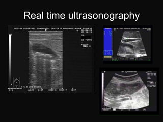 Real time ultrasonography
 