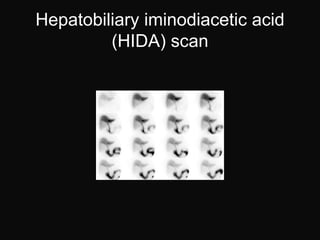 Hepatobiliary iminodiacetic acid
         (HIDA) scan
 
