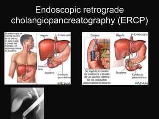 Endoscopic retrograde
cholangiopancreatography (ERCP)
 