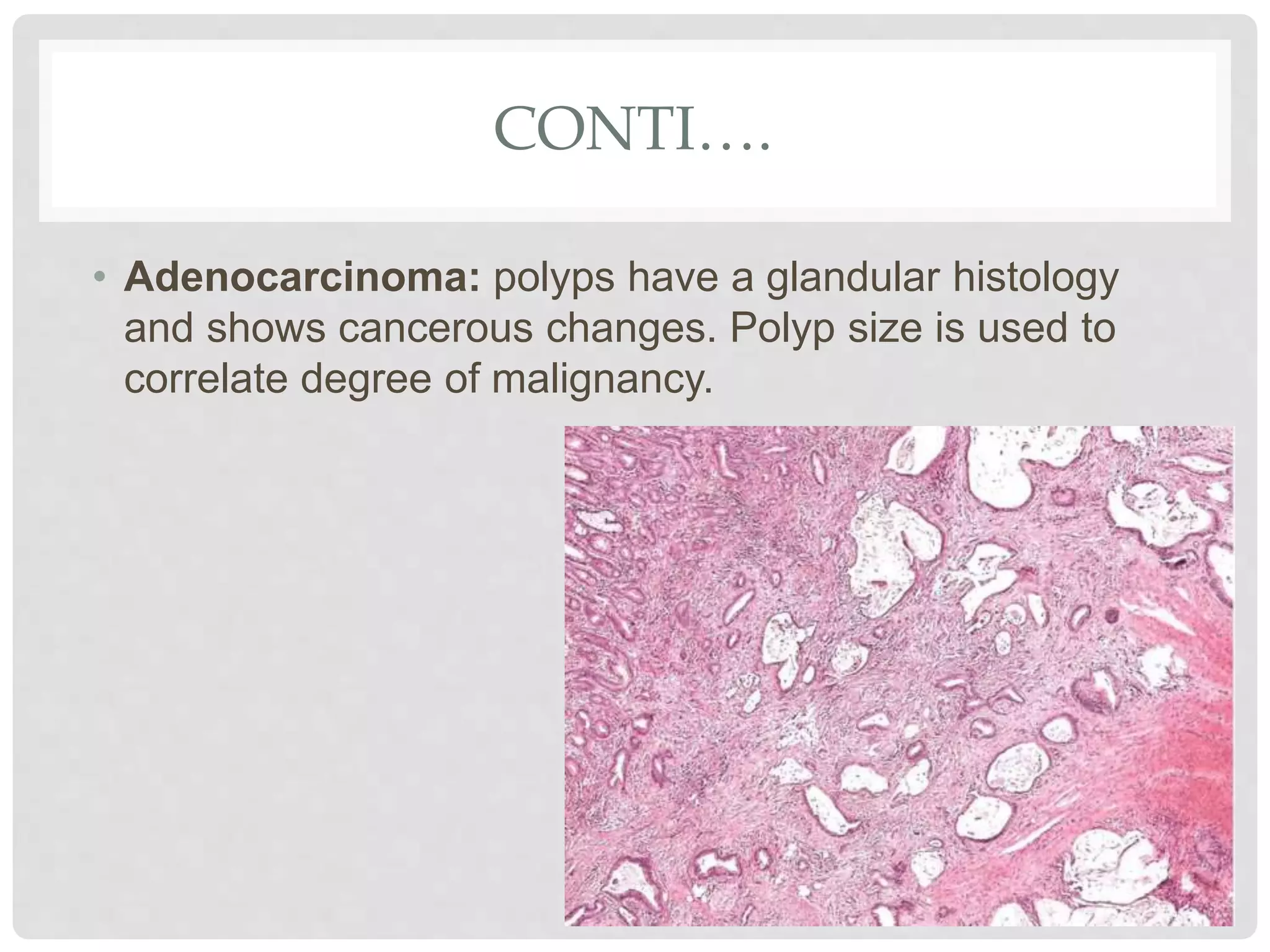 CONTI….
• Adenocarcinoma: polyps have a glandular histology
and shows cancerous changes. Polyp size is used to
correlate degree of malignancy.
 