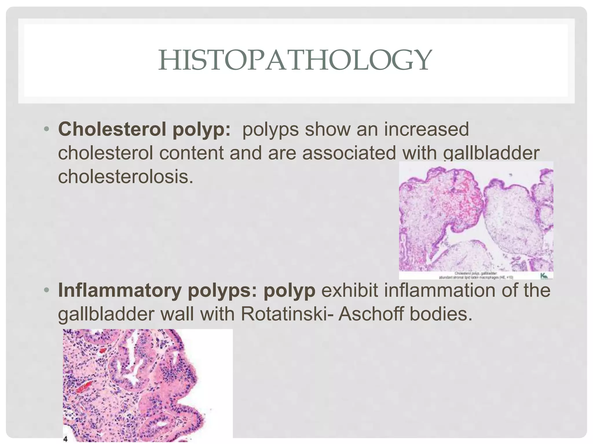 HISTOPATHOLOGY
• Cholesterol polyp: polyps show an increased
cholesterol content and are associated with gallbladder
cholesterolosis.
• Inflammatory polyps: polyp exhibit inflammation of the
gallbladder wall with Rotatinski- Aschoff bodies.
 