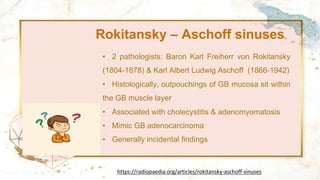 Rokitansky – Aschoff sinuses
• 2 pathologists: Baron Karl Freiherr von Rokitansky
(1804-1878) & Karl Albert Ludwig Aschoff (1866-1942)
• Histologically, outpouchings of GB mucosa sit within
the GB muscle layer
• Associated with cholecystitis & adenomyomatosis
• Mimic GB adenocarcinoma
• Generally incidental findings
https://radiopaedia.org/articles/rokitansky-aschoff-sinuses
 
