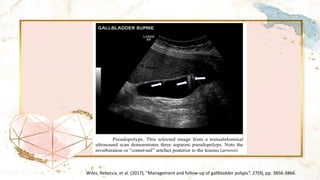 Wiles, Rebecca, et al. (2017), "Management and follow-up of gallbladder polyps". 27(9), pp. 3856-3866.
 