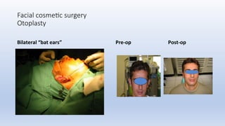 Facial cosme+c surgery
Otoplasty
Bilateral	“bat	ears”	 Pre-op																													Post-op	
 