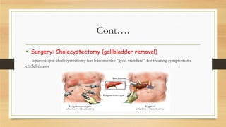 Cont….
• Surgery: Cholecystectomy (gallbladder removal)
laparoscopic cholecystectomy has become the "gold standard" for treating symptomatic
cholelithiasis

 