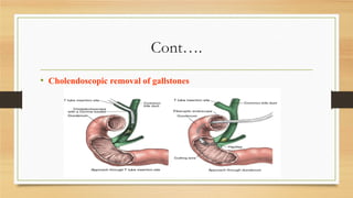 Cont….
• Cholendoscopic removal of gallstones

 