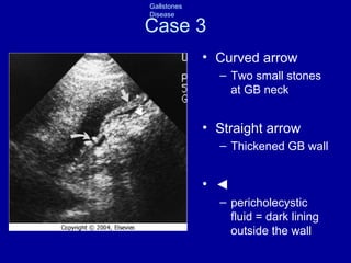 Case 3 Curved arrow Two small stones at GB neck Straight arrow Thickened GB wall ◄   pericholecystic fluid = dark lining outside the wall ◄ 