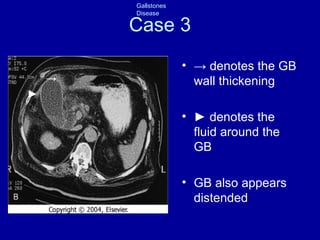 Case 3 ->  denotes the GB wall thickening ►  denotes the fluid around the GB GB also appears distended -> ► 