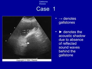 Case  1 ->  denotes gallstones ►   denotes the acoustic shadow due to absence of reflected sound waves behind the gallstone -> -> ► 