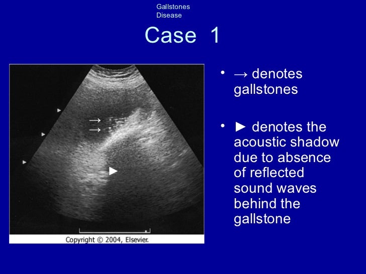 Gallstone+disease