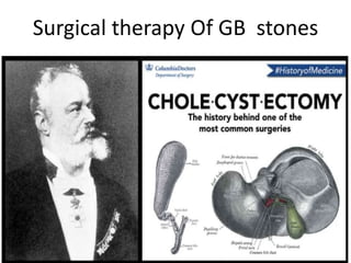 Surgical therapy Of GB stones
 