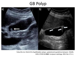 GB Polyp
Foley KG et al. Mx & F/U of gallbladder polyps: updated joint guidelines between ESGAR,
EAES, EFISDS & ESGE. European radiology. 2021 Dec 17:1-1.
 