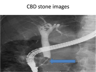 CBD stone images
 