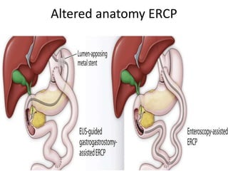 Altered anatomy ERCP
 