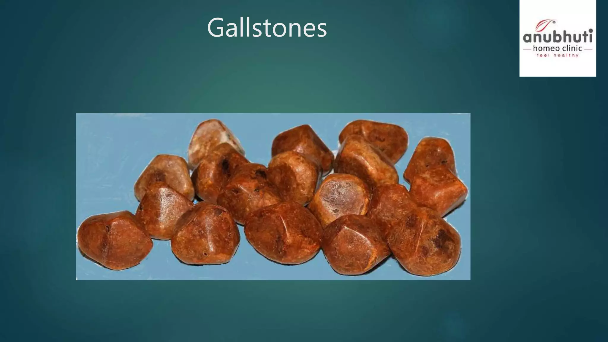 Gallstone gallbladder homeopathy treatment by anubhuti homeopathy ...