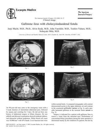 The American Journal of Surgery 183 (2002) 56 –57
                                                                Clinical image

                          Gallstone ileus with cholecystoduodenal ﬁstula
  Junji Machi, M.D., Ph.D., Alvin Ikeda, M.D., John Yarofalir, M.D., Toshiro Yahara, M.D.,
                                    Nobuyuki Miki, M.D.
                      University of Hawaii and Kuakini Medical Center, 405 N. Kuakini St., Suite 601, Honolulu, HI 96817, USA




                                                                                                             Fig. 3.
                                Fig. 1.




                                                                                                             Fig. 4.
                                Fig. 2.
                                                                              within normal limits. A computed tomography with contrast
                                                                              demonstrated ascites in the upper abdomen, air and contrast
An 88-year-old man came to the emergency room with a                          in the contracted gallbladder (arrow in Fig. 1), and a pos-
3-week duration of intermittent abdominal pain, followed                      sible laminated gallstone at the terminal ileum (arrow in
by nausea and vomiting for 3 days. He did not have any                        Fig. 2).
history of abdominal surgery or biliary diseases. He was                         Surgery is indicated for a patient with gallstone ileus to
afebrile and physical examination showed moderate abdom-                      remove a stone from the intestinal tract. Performance of
inal distension without tenderness. White blood cell count                    concomitant biliary procedures during the same operation is
was 10,900/mm3 with 45% bands. Liver function tests were                      determined mainly by the condition of a patient, but also by

0002-9610/02/$ – see front matter © 2002 Excerpta Medica, Inc. All rights reserved.
PII: S 0 0 0 2 - 9 6 1 0 ( 0 1 ) 0 0 8 3 0 - 3
 