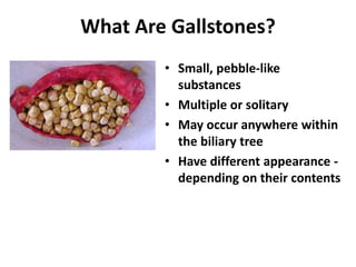 What Are Gallstones?
• Small, pebble-like
substances
• Multiple or solitary
• May occur anywhere within
the biliary tree
• Have different appearance -
depending on their contents
 