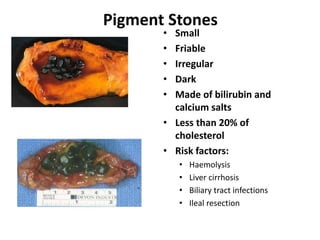 Pigment Stones
• Small
• Friable
• Irregular
• Dark
• Made of bilirubin and
calcium salts
• Less than 20% of
cholesterol
• Risk factors:
• Haemolysis
• Liver cirrhosis
• Biliary tract infections
• Ileal resection
 