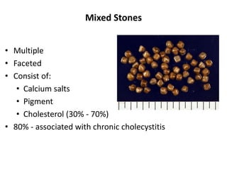 Mixed Stones
• Multiple
• Faceted
• Consist of:
• Calcium salts
• Pigment
• Cholesterol (30% - 70%)
• 80% - associated with chronic cholecystitis
 