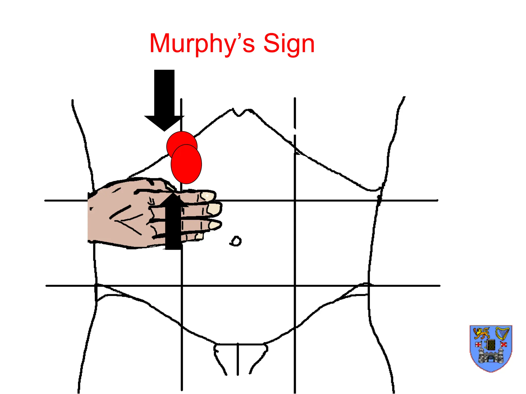 Murphy’s Sign
 