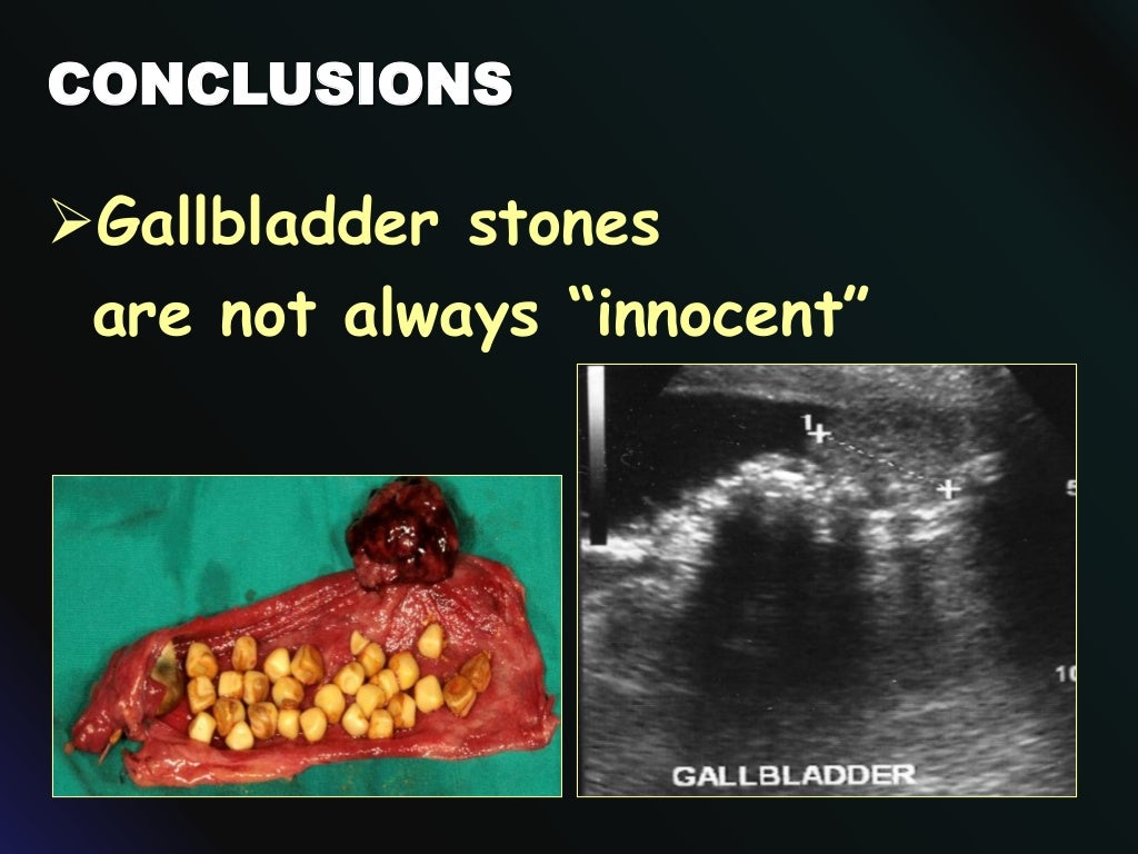 Gallstones on Ultrasound Are Gallstones Always Innocent?