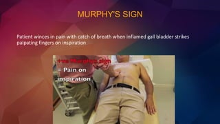 MURPHY'S SIGN
Patient winces in pain with catch of breath when inflamed gall bladder strikes
palpating fingers on inspiration
 
