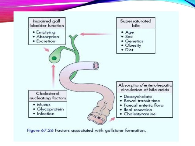 Gallstones And It S Complications