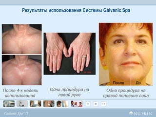 Результаты использования Системы  Galvanic Spa Одна процедура на левой руке До После Одна процедура на правой половине лица После 4-х недель использования  
