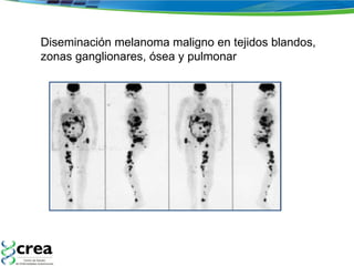 Diseminación melanoma maligno en tejidos blandos,  zonas ganglionares, ósea y pulmonar  