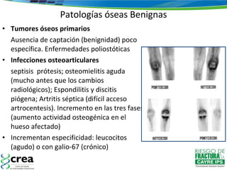 Patologías óseas Benignas Tumores óseos primarios Ausencia de captación (benignidad) poco específica. Enfermedades poliostóticas Infecciones osteoarticulares septisis  prótesis; osteomielitis aguda (mucho antes que los cambios radiológicos); Espondilitis y discitis piógena; Artritis séptica (difícil acceso artrocentesis). Incremento en las tres fases (aumento actividad osteogénica en el hueso afectado) Incrementan especificidad: leucocitos (agudo) o con galio-67 (crónico) 