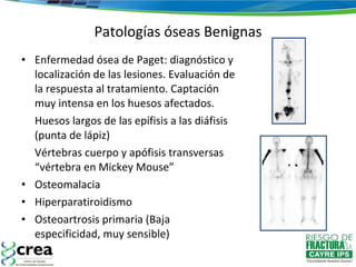 Patologías óseas Benignas Enfermedad ósea de Paget: diagnóstico y localización de las lesiones. Evaluación de la respuesta al tratamiento. Captación muy intensa en los huesos afectados. Huesos largos de las epífisis a las diáfisis (punta de lápiz) Vértebras cuerpo y apófisis transversas “vértebra en Mickey Mouse” Osteomalacia  Hiperparatiroidismo Osteoartrosis primaria (Baja especificidad, muy sensible) 