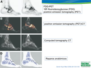 FDG-PET  18F-fluorodeoxyglucose (FDG) positron emission tomography (PET)  positron emission tomography (PET)/CT Computed tomography CT Reparos anatómicos Semin Nucl Med 2009;39:124-145 