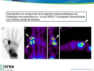 Gamagrafía con compromiso de la segunda metacarpofalángica (a). Hallazgos más específicos (b – d) con SPECT (Tomografía computarizada  con emisión simple de fotones) Skeletal Radiol (2010) 39:55–61 