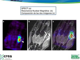 SPECT (a) Resonancia Nuclear Magnética  (b) Composición de las dos imágenes (c) 