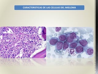 CARACTERISTICAS DE LAS CELULAS DEL MIELOMA
 