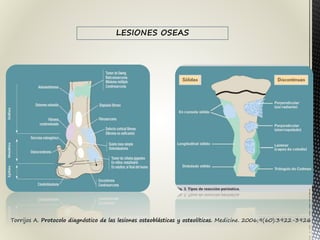 Torrijos A. Protocolo diagnóstico de las lesiones osteoblásticas y osteolíticas. Medicine. 2006;9(60):3922-3926
LESIONES OSEAS
 