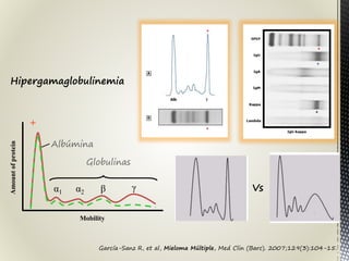 García-Sanz R, et al, Mieloma Múltiple, Med Clin (Barc). 2007;129(3):104-15.
α1 α2 β γ
+ -
Albúmina
Globulinas
Mobility
Amountofprotein
Hipergamaglobulinemia
Vs
 