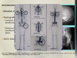 Niels W.C. Diagnosis and Risk Stratification in Multiple Myeloma. Hematol Oncol Clin N Am 28 (2014) 791–813
EXPLORACIONES COMPLEMENTARIAS:
Estudios de imagen:
Radiografía convencional
Lesiones osteolíticas en
sacabocado
Destrucciones parciales o
insuflaciones de plasmocitomas
óseos.
Serie ósea metastasica
García-Sanz R, et al, Mieloma Múltiple, Med Clin (Barc). 2007;129(3):104-15
 