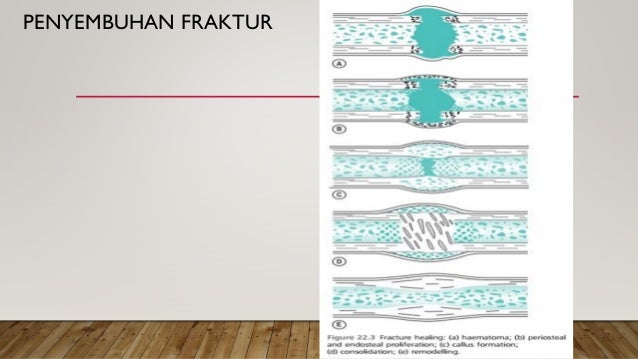 Gambaran Klinis Fraktur