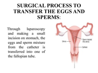 SURGICAL PROCESS TO
TRANSFER THE EGGS AND
SPERMS:
Through laparoscopy
and making a small
incision on stomach, the
eggs and sperm mixture
from the catheter is
transferred into one of
the fallopian tube.
 
