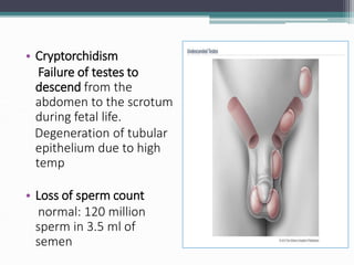 • Cryptorchidism
Failure of testes to
descend from the
abdomen to the scrotum
during fetal life.
Degeneration of tubular
epithelium due to high
temp
• Loss of sperm count
normal: 120 million
sperm in 3.5 ml of
semen
 