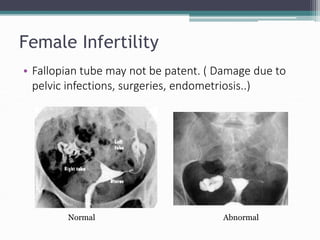 Female Infertility
• Fallopian tube may not be patent. ( Damage due to
pelvic infections, surgeries, endometriosis..)
Normal Abnormal
 