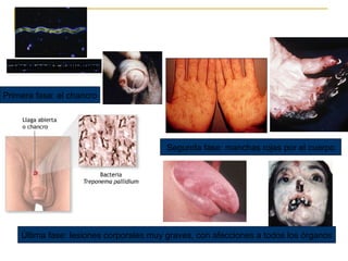 SÍFILIS
Treponema pallidum
Primera fase: el chancro
Segunda fase: manchas rojas por el cuerpo
Última fase: lesiones corporales muy graves, con afecciones a todos los órganos
 