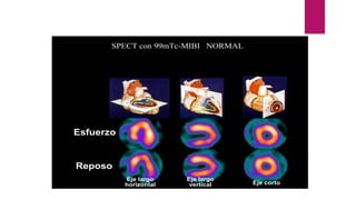 Esfuerzo
Reposo
Eje largo
vertical
Eje largo
horizontal Eje corto
SPECT con 99mTc-MIBI NORMAL
 