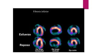 Esfuerzo
Reposo
Eje largo
vertical
Eje largo
horizontal Eje corto
Fibrosis inferior
 
